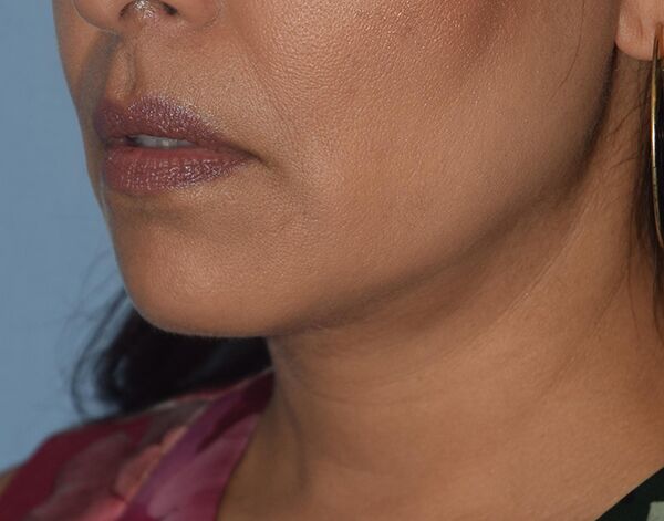 Double Chin Correction Case 1088 After Photo Double Chin Correction