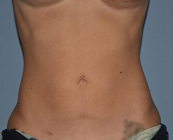 Liposuction Case 1089 After Photo Liposuction