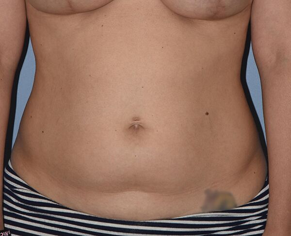 Liposuction Case 1089 Before Photo Liposuction