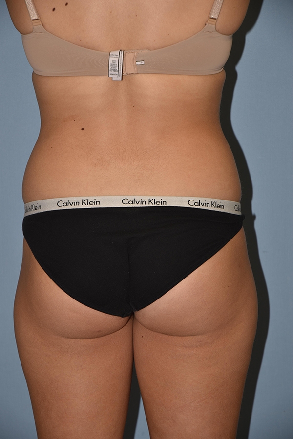 Liposuction