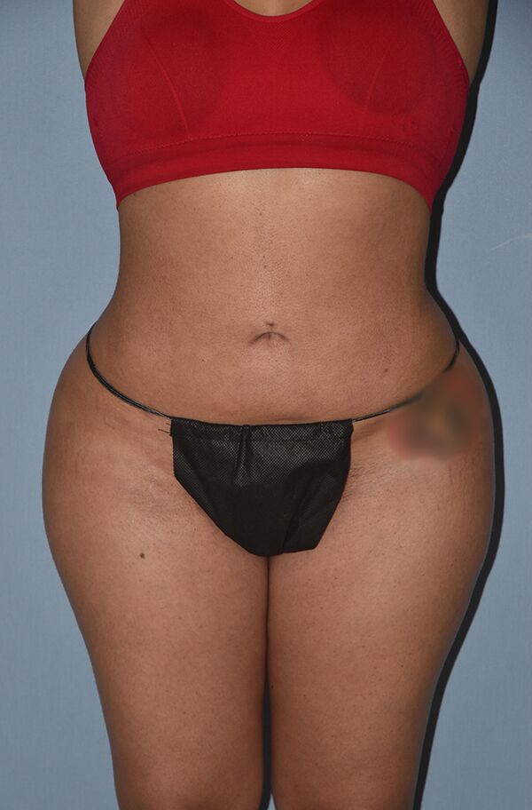 Liposuction Case 1456 After Photo Liposuction