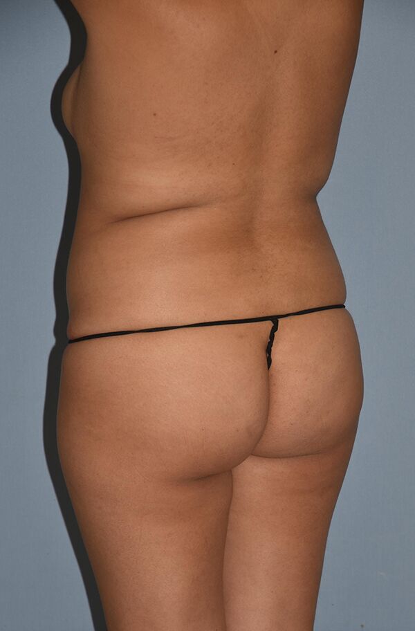 Liposuction