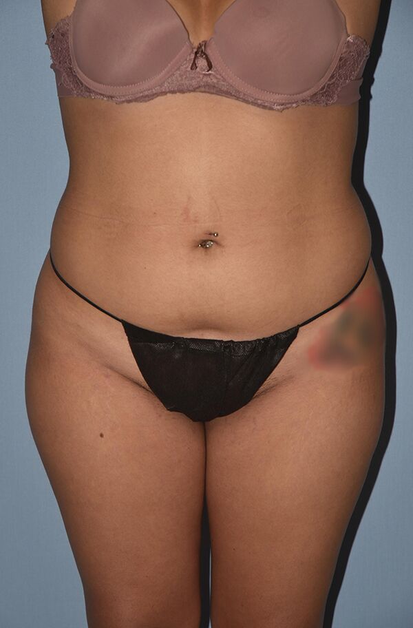 Liposuction Case 1456 Before Photo Liposuction