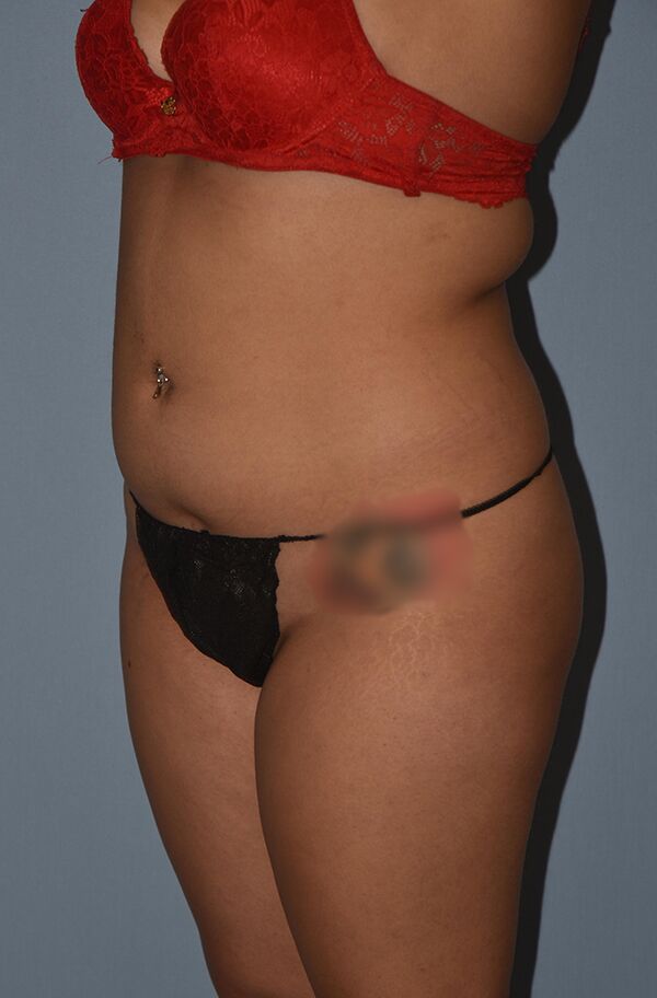 Buttock Augmentation