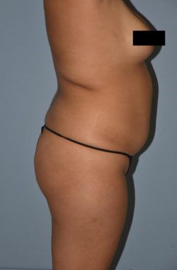 Buttock Augmentation