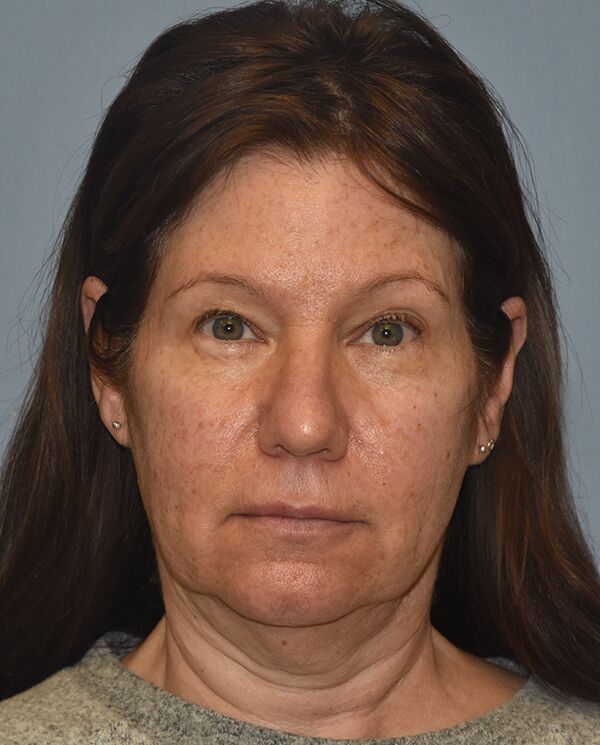 Facelift