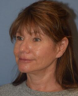 Facelift
