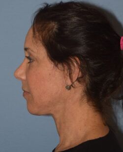Facelift