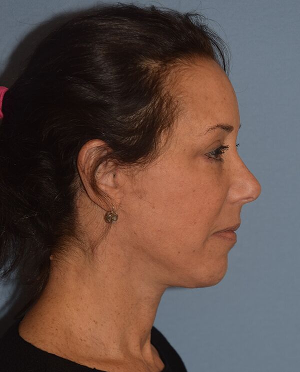 Facelift