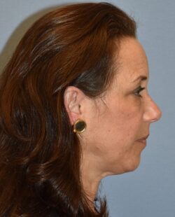 Facelift