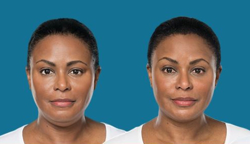 Kybella before and after photo by Dr. Erika A. Sato in Houston TX