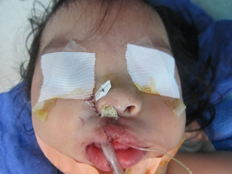 Sato's kid patient in Guatemala