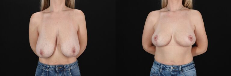 Breast Lift Before and After Photo by Dr. Erika A. Sato in Houston TX