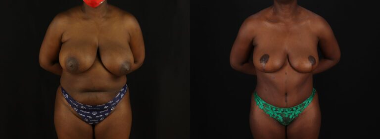 Tummy Tuck Before and After Photo by Dr. Erika A. Sato in Houston TX