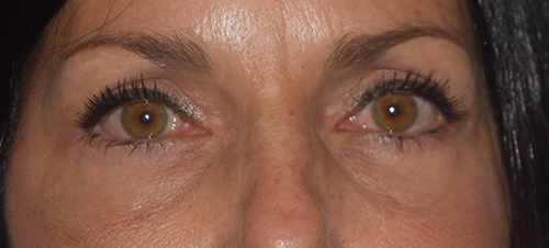 Blepharoplasty
