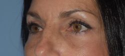 Blepharoplasty