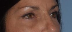 Blepharoplasty