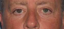 Lower Eyelid Blepharoplasty