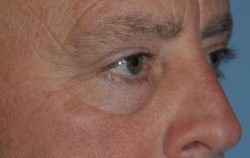 Lower Eyelid Blepharoplasty