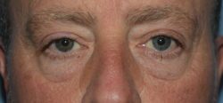 Lower Eyelid Blepharoplasty