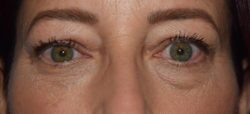 Blepharoplasty