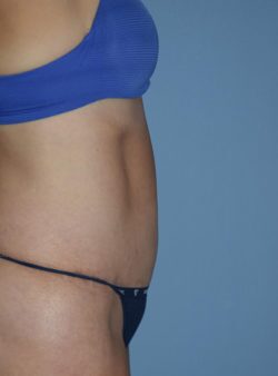 Tummy Tuck
