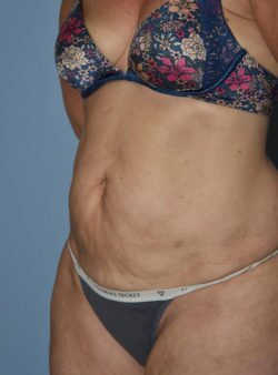Tummy Tuck