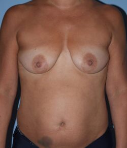 Breast Reconstruction (Implants)