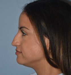 Rhinoplasty