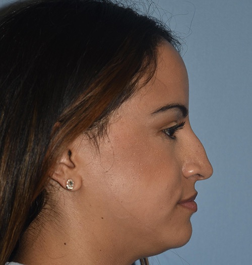 Rhinoplasty