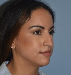 Rhinoplasty