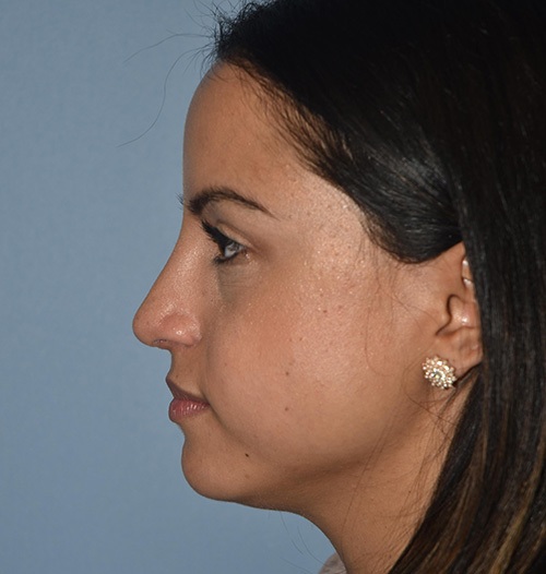 Rhinoplasty