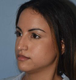 Rhinoplasty