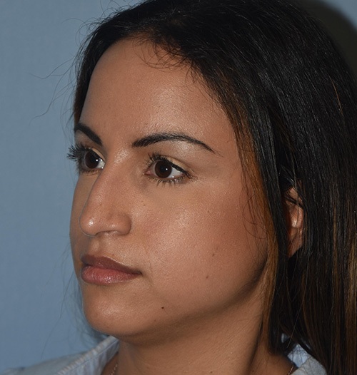 Rhinoplasty