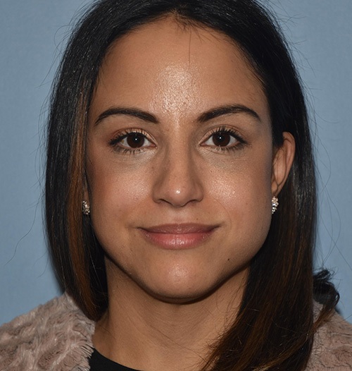 Rhinoplasty Case 821 After Photo Rhinoplasty