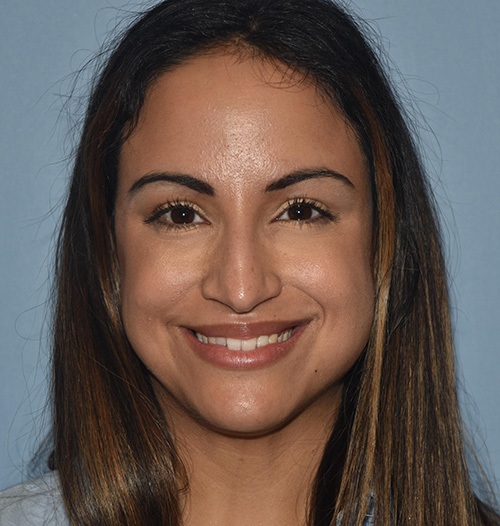 Rhinoplasty