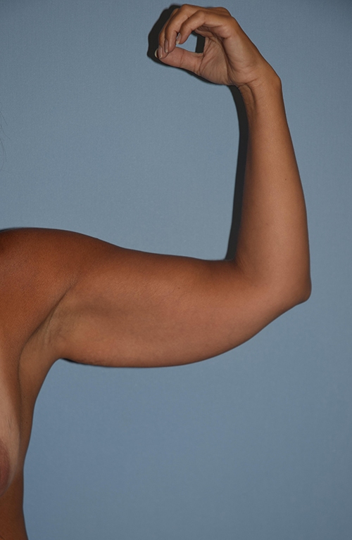 Arm lift results image