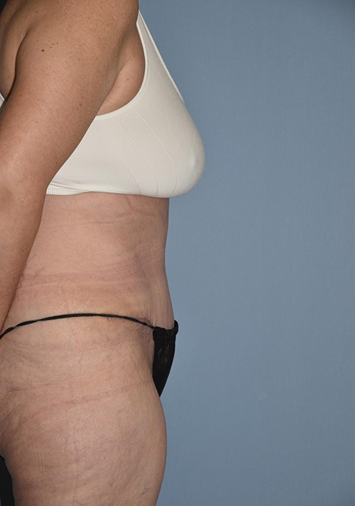 Tummy Tuck