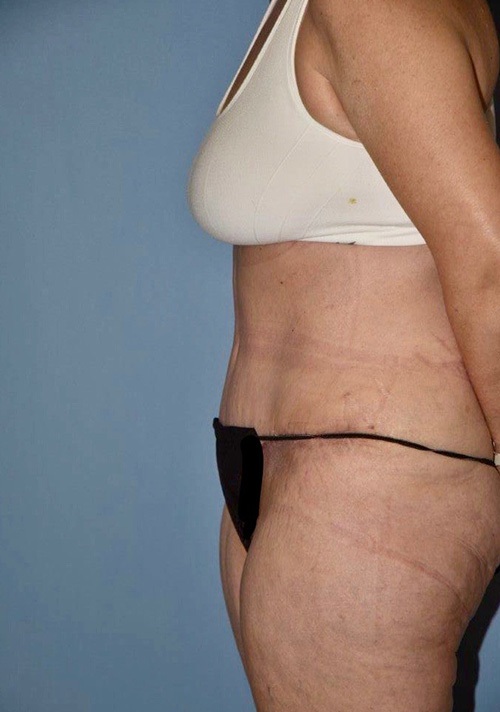 Tummy Tuck
