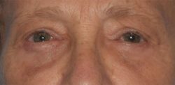 Blepharoplasty