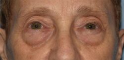 Blepharoplasty