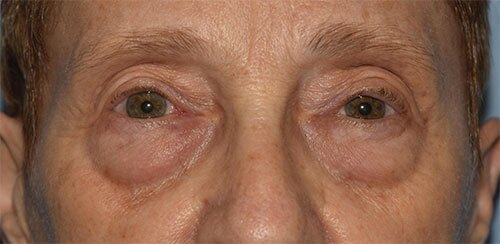 Blepharoplasty Case 1011 Before Photo Blepharoplasty