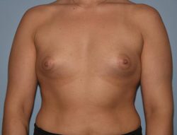 Breast Augmentation