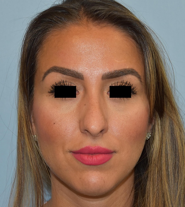 Rhinoplasty Case 1217 Before Photo Rhinoplasty