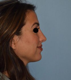 Rhinoplasty