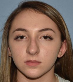 Rhinoplasty