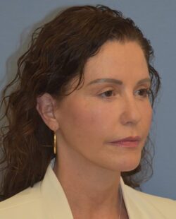 Facelift