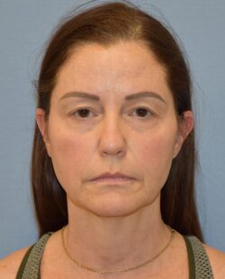 Facelift