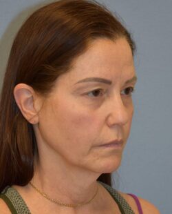 Facelift