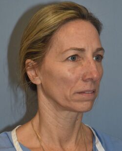 Facelift